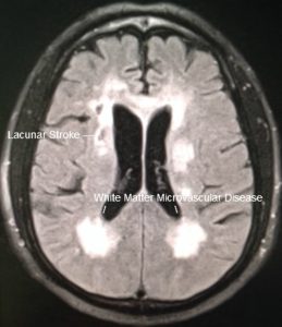 CADASIL Migraine